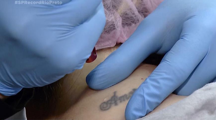 Aumenta procura por remoção de tatuagens em Rio Preto