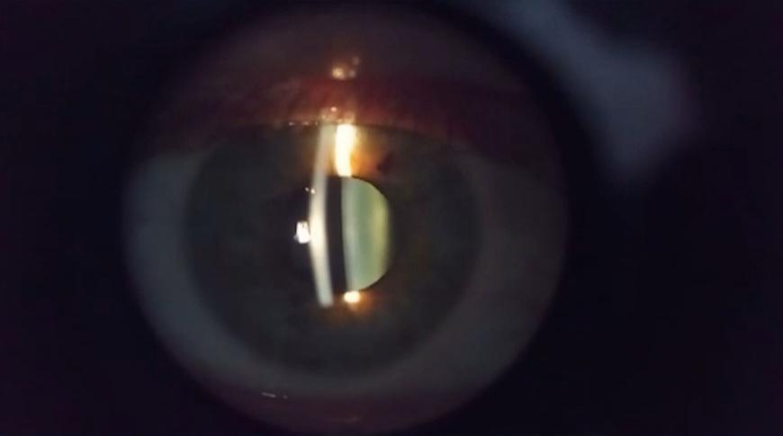 Diagnóstico precoce de retinoblastoma aumenta as chances de cura
