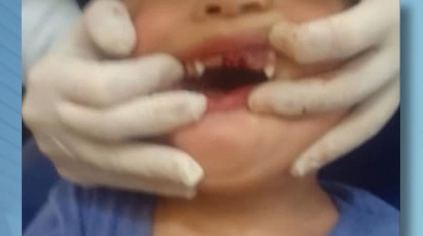 Menino perde dois dentes em creche de Mirassol
